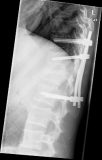 spine